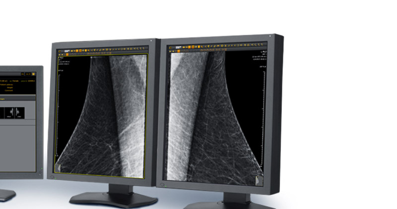 Mammography a blessing to early detection of breast cancer