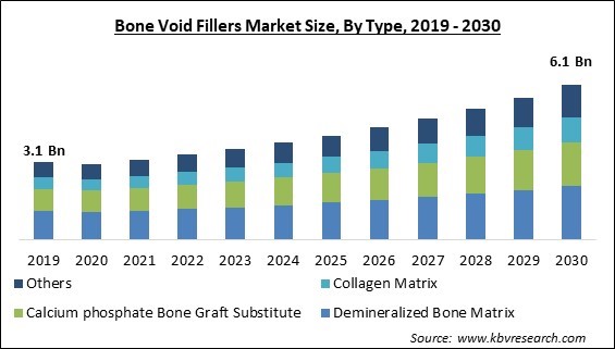 Bone Void Fillers Market Size - Global Opportunities and Trends Analysis Report 2019-2030